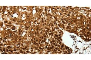 Immunohistochemistry of paraffin-embedded Human cervical cancer tissue using SCN1A Polyclonal Antibody at dilution 1:40 (SCN1A anticorps)