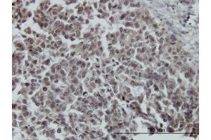 Immunoperoxidase of monoclonal antibody to FOXO3A on formalin-fixed paraffin-embedded human breast cancer. (FOXO3 anticorps  (AA 361-460))