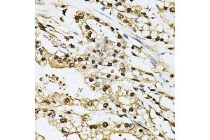 Immunohistochemistry of paraffin-embedded human prostate cancer using PSMB1 antibody.