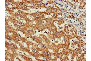 Immunohistochemistry of paraffin-embedded human liver cancer using ABIN7175855 at dilution of 1:100 (WISP3 anticorps  (AA 201-372))
