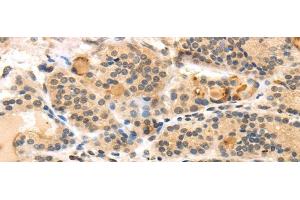 Immunohistochemistry of paraffin-embedded Human thyroid cancer using TUSC5 Polyclonal Antibody at dilution of 1/40 (TUSC5 anticorps)