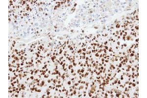IHC-P Image Immunohistochemical analysis of paraffin-embedded H1299 xenograft, using hnRNP K, antibody at 1:100 dilution.