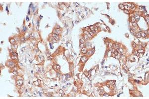 Immunohistochemistry of paraffin-embedded Human lung cancer using PTPRN2 Polyclonal Antibody at dilution of 1:100 (40x lens). (PTPRN2 anticorps)