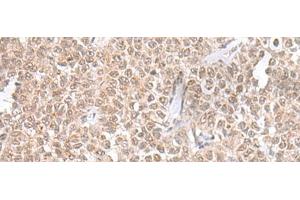 Immunohistochemistry of paraffin-embedded Human ovarian cancer tissue using THAP12 Polyclonal Antibody at dilution of 1:45(x200) (PRKRIR anticorps)