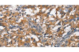 Immunohistochemistry of paraffin-embedded Human thyroid cancer tissue using DDR2 Polyclonal Antibody at dilution 1:40 (DDR2 anticorps)