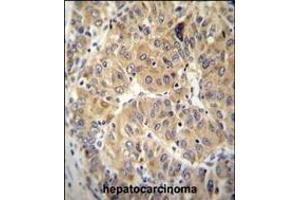 NARS Antibody (N-term) (ABIN655041 and ABIN2844672) immunohistochemistry analysis in formalin fixed and paraffin embedded human hepatocarcinoma followed by peroxidase conjugation of the secondary antibody and DAB staining. (NARS anticorps  (N-Term))
