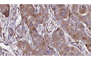 ABIN6276598 at 1/100 staining Human liver cancer tissue by IHC-P. (FCGR1A anticorps  (Internal Region))