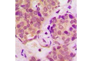 Immunohistochemical analysis of STAT6 (pY641) staining in human breast cancer formalin fixed paraffin embedded tissue section.