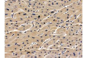 ABIN6259600 and ABIN6275767 at 1/100 staining human liver cancer by IHC-P. (HSPBAP1 anticorps  (Internal Region))