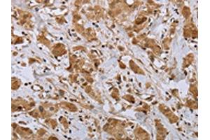 The image on the left is immunohistochemistry of paraffin-embedded Human breast cancer tissue using ABIN7191695(NPR2 Antibody) at dilution 1/45, on the right is treated with synthetic peptide. (NPR2 anticorps)