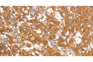 Immunohistochemistry of paraffin-embedded Human thyroid cancer using WNT3A Polyclonal Antibody at dilution of 1:40 (WNT3A anticorps)