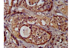 IHC image of ABIN7162085 diluted at 1:300 and staining in paraffin-embedded human cervical cancer performed on a Leica BondTM system. (NUMBL anticorps  (AA 447-576))