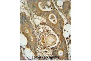 GCNT3 antibody (C-term) (ABIN654928 and ABIN2844571) immunohistochemistry analysis in formalin fixed and paraffin embedded human colon carcinoma followed by peroxidase conjugation of the secondary antibody and DAB staining. (GCNT3 anticorps  (C-Term))