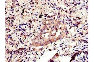 Immunohistochemistry of paraffin-embedded human lung cancer using ABIN7155812 at dilution of 1:100