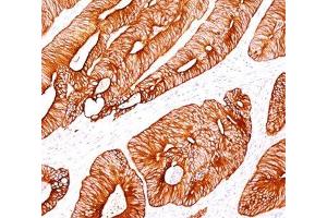 IHC testing of human colon carcinoma stained with Cytokeratin 8 antibody (K8/383). (KRT8 anticorps)