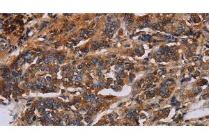 Immunohistochemistry of paraffin-embedded Human breast cancer using KCNQ1 Polyclonal Antibody at dilution of 1:50