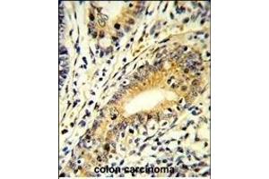 Formalin-fixed and paraffin-embedded human colon carcinoma reacted with FB Antibody (N-term), which was peroxidase-conjugated to the secondary antibody, followed by DAB staining.