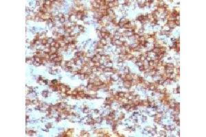 IHC testing of CD45RB antibody and FFPE human lymphoma (clone CDLA45RB-1).