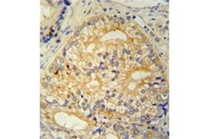 Formalin fixed and paraffin embedded human prostate carcinoma stained with CP013 Antibody (N-term) followed by peroxidase conjugation of the secondary antibody and DAB staining. (C16ORF13 anticorps  (N-Term))