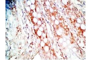 Human colon cancer tissue was stained by Rabbit Anti-Gastrin Releasing Peptide (Porcine) Antibody