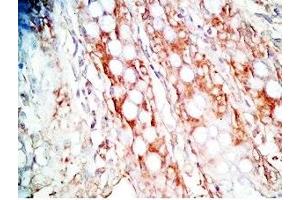 Human colon cancer tissue was stained by Rabbit Anti-Gastrin Releasing Peptide (Porcine) Antibody (Gastrin-Releasing Peptide anticorps)