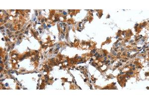 Immunohistochemistry of paraffin-embedded Human thyroid cancer tissue using DEFA4 Polyclonal Antibody at dilution 1:40 (DEFA4 anticorps)