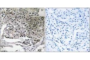 Immunohistochemistry analysis of paraffin-embedded human breast carcinoma tissue, using PIGY Antibody.