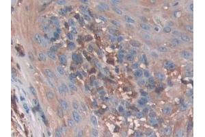 Detection of CFL1 in Human Skin cancer Tissue using Polyclonal Antibody to Cofilin 1 (CFL1)