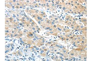 The image on the left is immunohistochemistry of paraffin-embedded Human liver cancer tissue using ABIN7190846(GPR15 Antibody) at dilution 1/20, on the right is treated with synthetic peptide. (GPR15 anticorps)