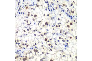 Immunohistochemistry of paraffin-embedded human kidney cancer using GTF2F2 antibody. (GTF2F2 anticorps)