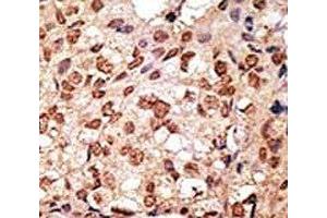 IHC analysis of FFPE human breast carcinoma stained with the SIGLEC7 antibody