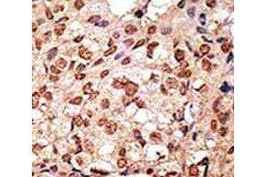 IHC analysis of FFPE human breast carcinoma stained with the SIGLEC7 antibody (SIGLEC7 anticorps  (AA 1-30))