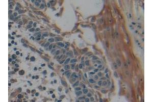 Detection of CK9 in Human Skin cancer Tissue using Polyclonal Antibody to Cytokeratin 9 (CK9)