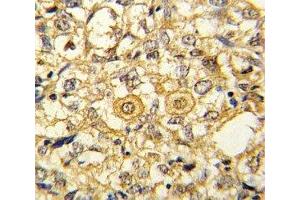 IHC analysis of FFPE human breast carcinoma stained with PDGFR beta antibody