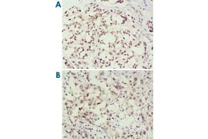 Immunohistochemical analysis of paraffin-embedded human breast cancer (A) and lung cancer (B) tissues, showing nuclear localization using MSH2 monoclonal antibody, clone 3A2B8C  with DAB staining.