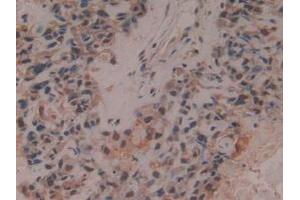 Detection of PSMD13 in Human Lung Cancer Tissue using Polyclonal Antibody to Proteasome 26S Subunit, Non ATPase 13 (PSMD13)