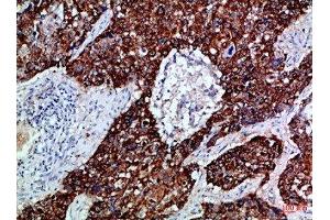 Immunohistochemical analysis of paraffin-embedded Human-lung-cancer, antibody was diluted at 1:100