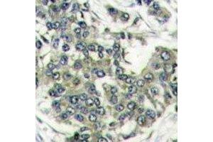 IHC analysis of FFPE human breast carcinoma stained with EIF4E antibody