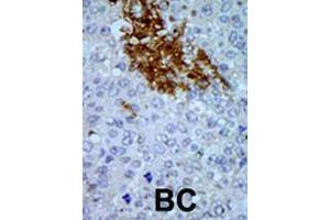 Formalin-fixed and paraffin-embedded human cancer tissue reacted with the primary antibody, which was peroxidase-conjugated to the secondary antibody, followed by AEC staining. (PNCK anticorps  (C-Term))