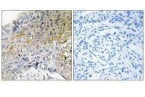 Immunohistochemical analysis of paraffin-embedded human breast carcinoma tissue using p130 Cas (Ab-410) antibody.