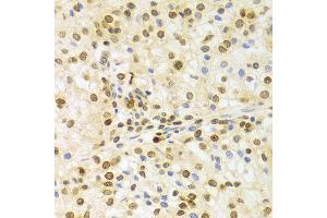 Immunohistochemistry of paraffin-embedded Human kidney cancer using ELAVL1 antibody at dilution of 1:100 (x400 lens).
