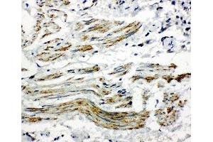 IHC-P: Caveolin-2 antibody testing of human lung cancer tissue