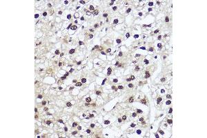 Immunohistochemistry of paraffin-embedded human liver cancer using NFIA Rabbit pAb (ABIN1681040, ABIN3017626, ABIN3017627 and ABIN6220178) at dilution of 1:200 (40x lens).