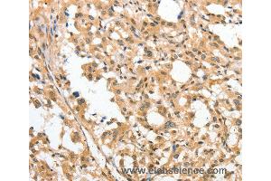 Immunohistochemistry of Human cervical cancer using APTX Polyclonal Antibody at dilution of 1:50 (Aprataxin anticorps)
