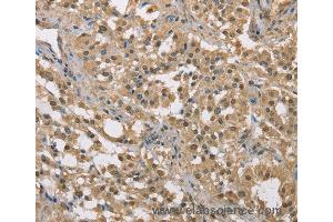 Immunohistochemistry of Human liver cancer using DACH2 Polyclonal Antibody at dilution of 1:40 (DACH2 anticorps)