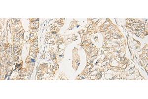 Immunohistochemistry of paraffin-embedded Human gastric cancer tissue using EIF2S2 Polyclonal Antibody at dilution of 1:35(x200) (EIF2S2 anticorps)