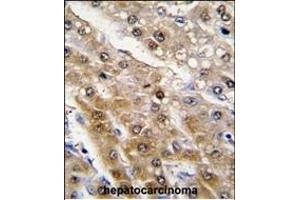 Formalin-fixed and paraffin-embedded human hepatocarcinoma tissue reacted with ALDH9A1 antibody (N-term), which was peroxidase-conjugated to the secondary antibody, followed by DAB staining.