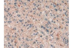 Detection of C6 in Human Glioma Tissue using Polyclonal Antibody to Complement Component 6 (C6)
