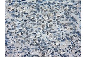 Immunohistochemical staining of paraffin-embedded Carcinoma of thyroid tissue using anti-BUB1Bmouse monoclonal antibody. (BUB1B anticorps)