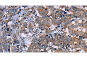Immunohistochemistry of paraffin-embedded Human breast cancer using PON1 Polyclonal Antibody at dilution of 1:40
